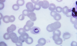 Plasmodium ovale